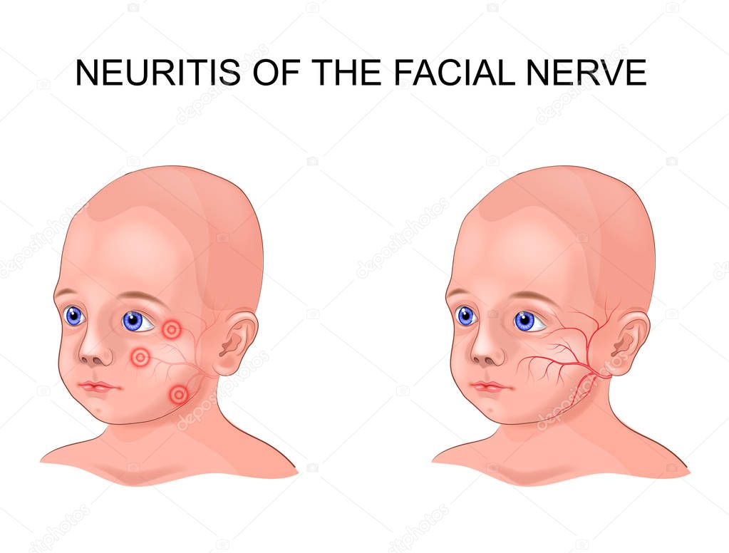 vector illustration of facial nerve neuritis in a child