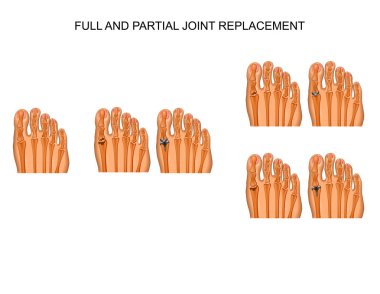 ayak başparmağı eklem parsiyel ve komple artroplasti vektör çizim