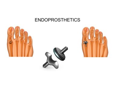 vector illustration of complete arthroplasty of the big toe joint clipart
