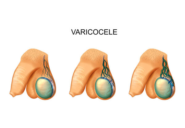 vector illustration of a varicocele in the testicle