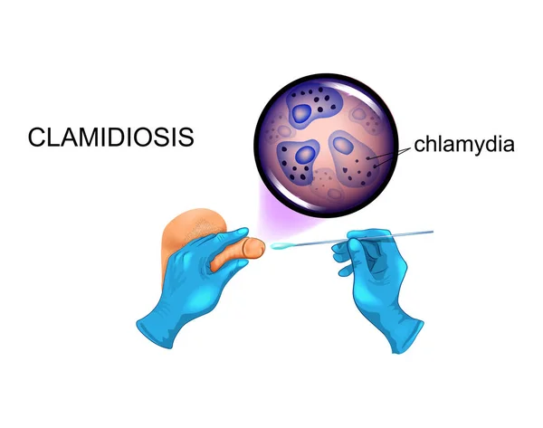 Illustration Vectorielle Écouvillon Chlamydia Pénis — Image vectorielle