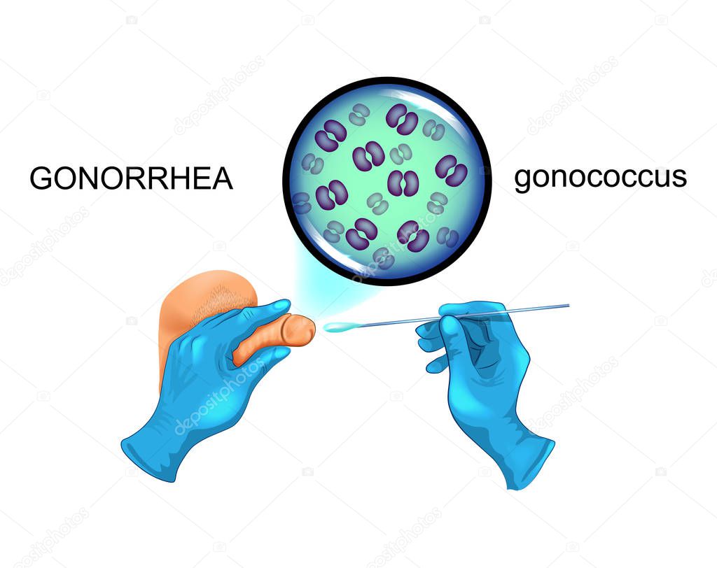 vector illustration of a swab from the penis for gonorrhea