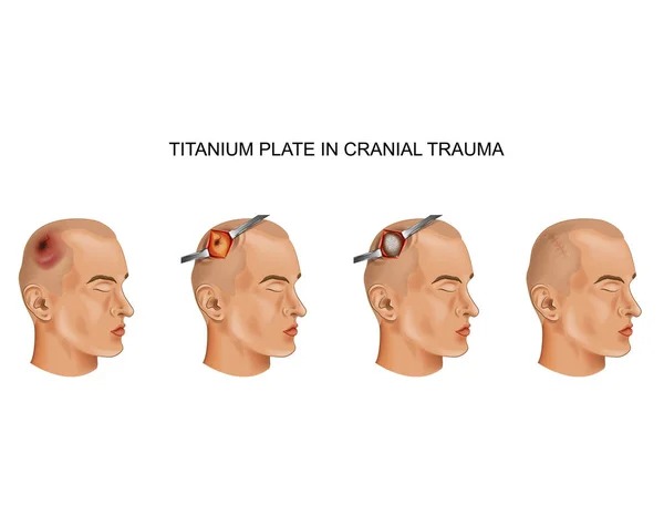 Ilustración Vectorial Placa Titanio Lesión Cerebral Traumática — Archivo Imágenes Vectoriales