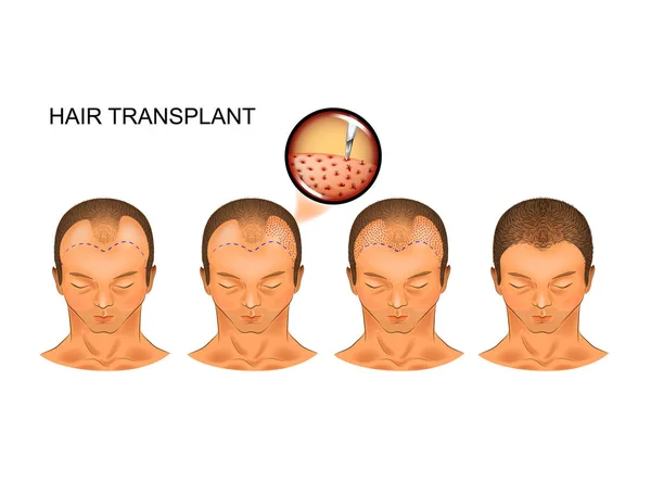 Vektor Illustration Des Prozesses Der Haartransplantation Des Hinteren Kopfes — Stockvektor