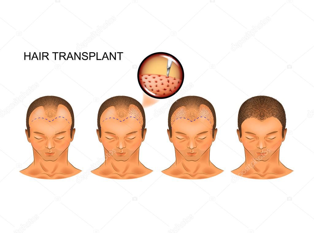 vector illustration of the process of hair transplantation of the occipital part of the head
