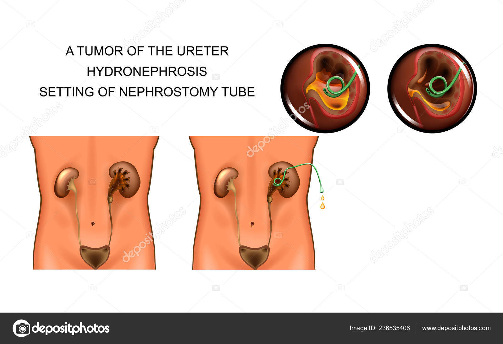 Hidronefrosis