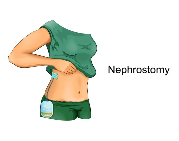 Ilustración Vectorial Nefrostomía Del Riñón Derecho Con Una Bolsa Orina — Archivo Imágenes Vectoriales