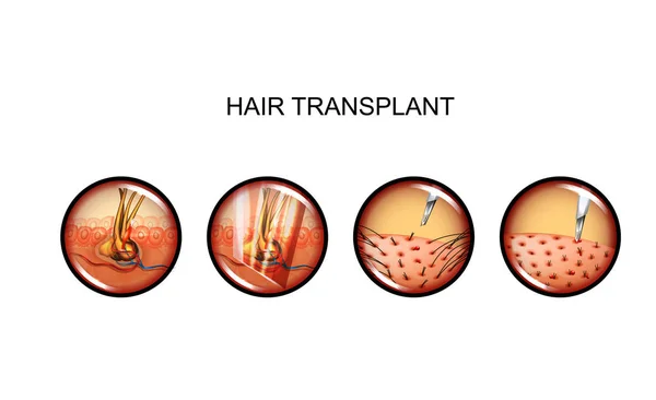 Ilustração Vetorial Transplante Capilar Cabeça Alopécia —  Vetores de Stock