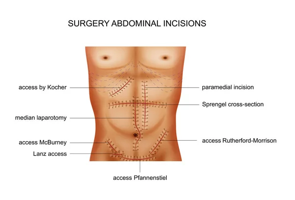 Ilustração Vetorial Das Incisões Cirúrgicas Cavidade Abdominal — Vetor de Stock