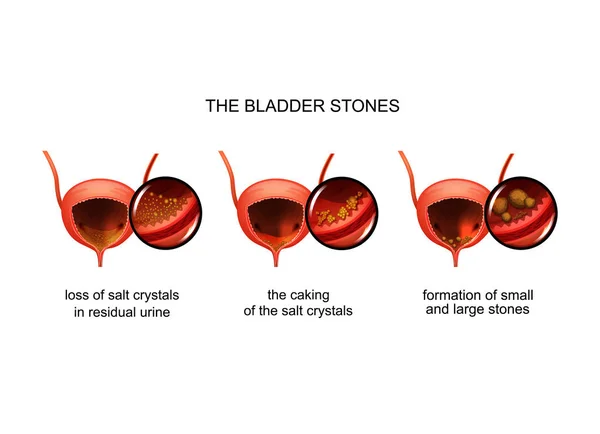 Vector illustration of the formation of stones in the bladder — Stock Illustration Vector Illustration Formation Stones Bladder Royalty Free Stock Illustrations