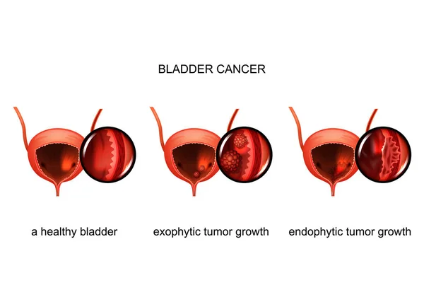 Vector illustration of exophytic and endophytic growth of cancer in the bladder — Stock Illustration Vector Illustration Exophytic Endophytic Growth Cancer Bladder Stock Vector