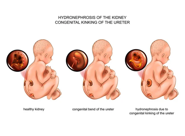 Vector Illustration Hydronephrosis Due Congenital Ureteral Curvature — Stock Vector