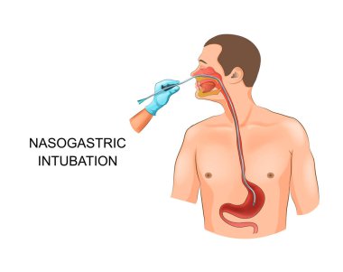 nazogastrik entübasyon vektör Illustration. midesinde tüp