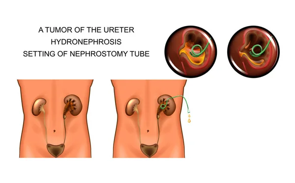 Vector illustration of tumor of the ureter. hydronephrosis. setting of nephrostomy tube — Stock Illustration Vector Illustration Tumor Ureter Hydronephrosis Setting Nephrostomy Tube Royalty Free Stock Illustrations