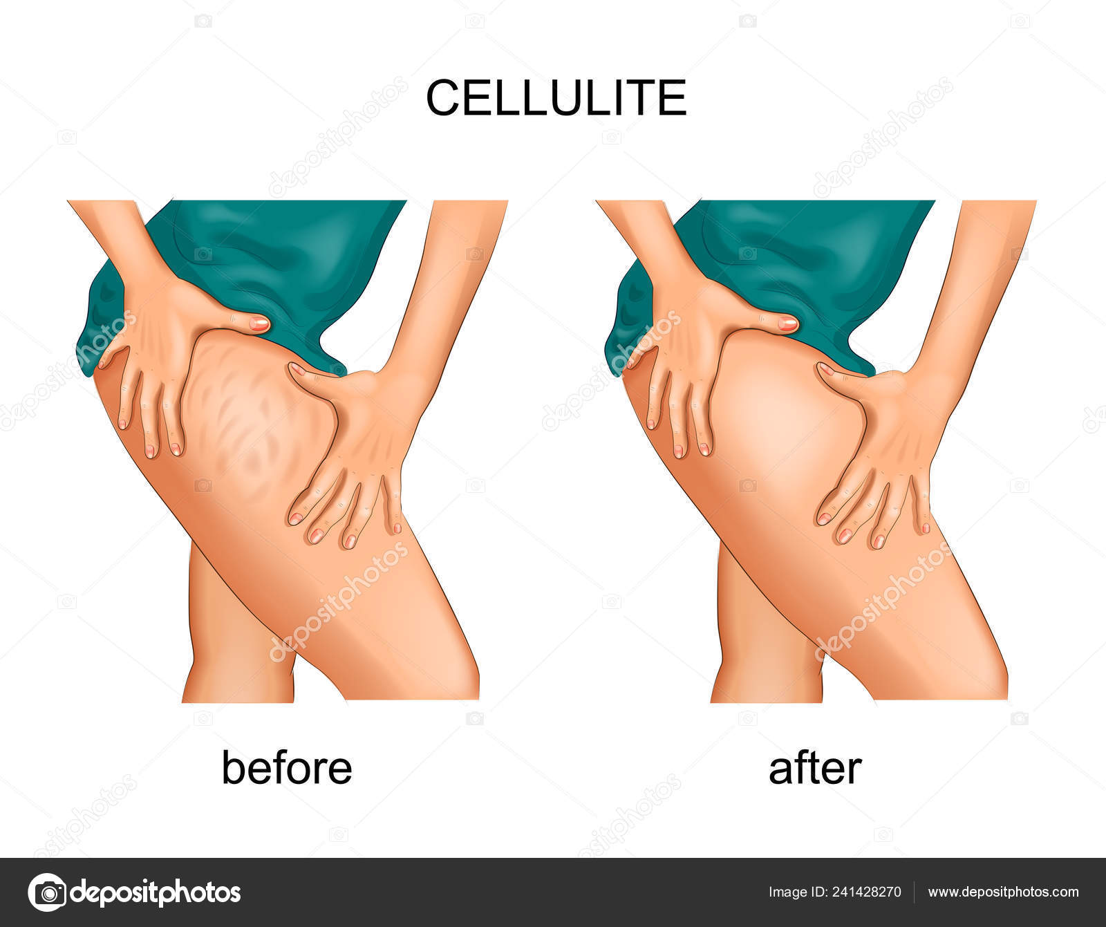 Illustration Vectorielle Cellulite Sur Les Cuisses Femme