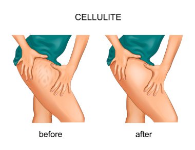 vector illustration of cellulite on a woman's thigh clipart