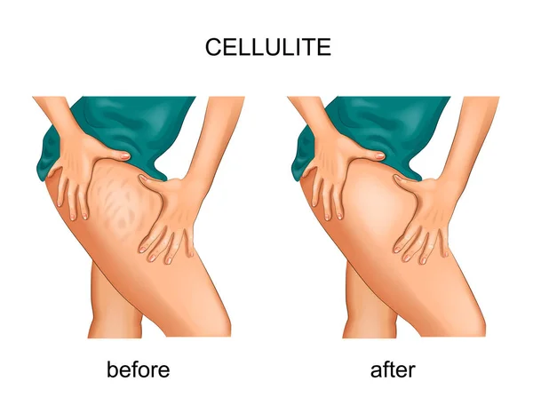 Illustration Vectorielle Cellulite Sur Cuisse Une Femme — Image vectorielle