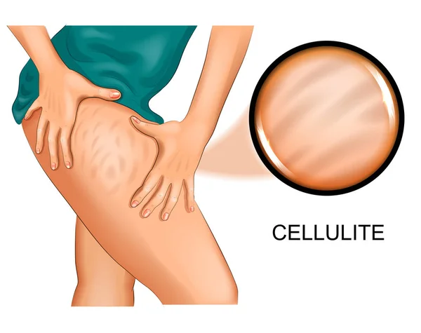 Vectorillustratie Van Cellulitis Een Vrouw Dij — Stockvector