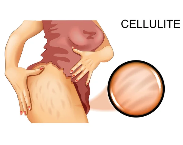 Ilustración Vectorial Celulitis Muslo Una Mujer — Vector de stock