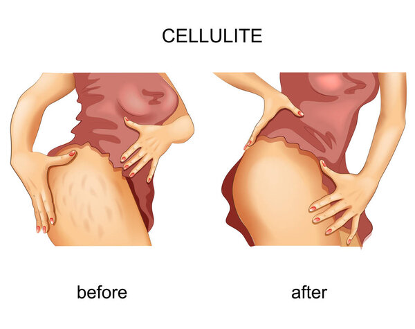 vector illustration of cellulite on a woman's thigh