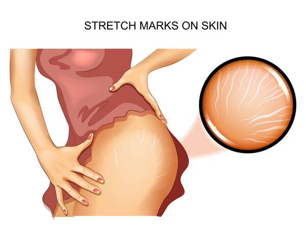 vector illustration of stretch marks on the skin.