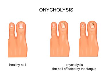 vector illustration of fungal nail infection, onycholysis clipart