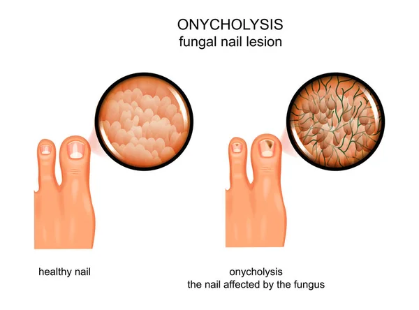 Vector Illustration Fungal Nail Lesion Infection Onycholysis — Stock Vector