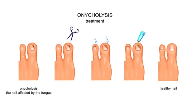 Ilustração Vetorial Onicólise Infecção Unhas Fúngicas Tratamento —  Vetores de Stock