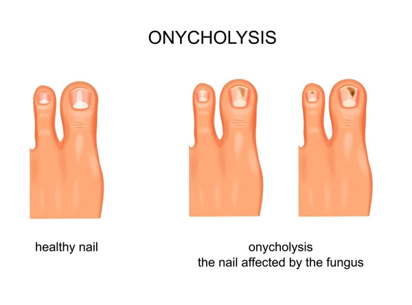 Vector Ilustración Infección Por Hongos Las Uñas Onicolisis — Vector de stock