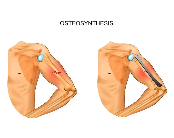 Illustrazione Vettoriale Dell Osteosintesi Del Corpo Dell Omero — Vettoriale Stock