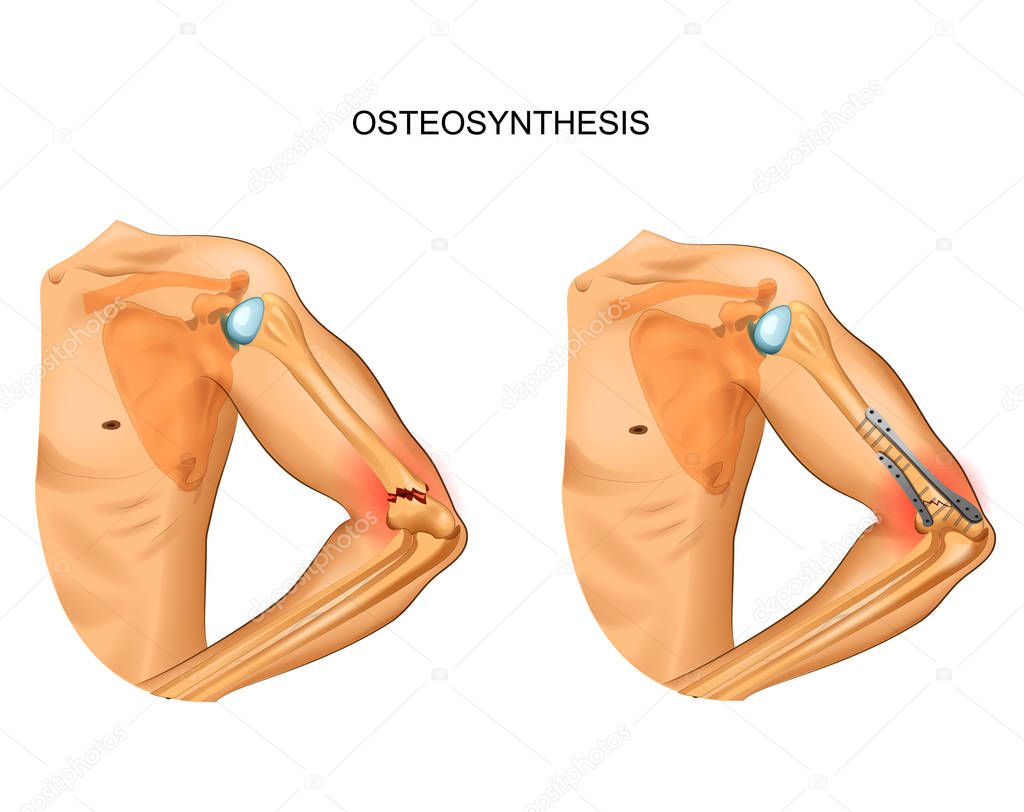 vector illustration of osteosynthesis in fracture of distal humerus