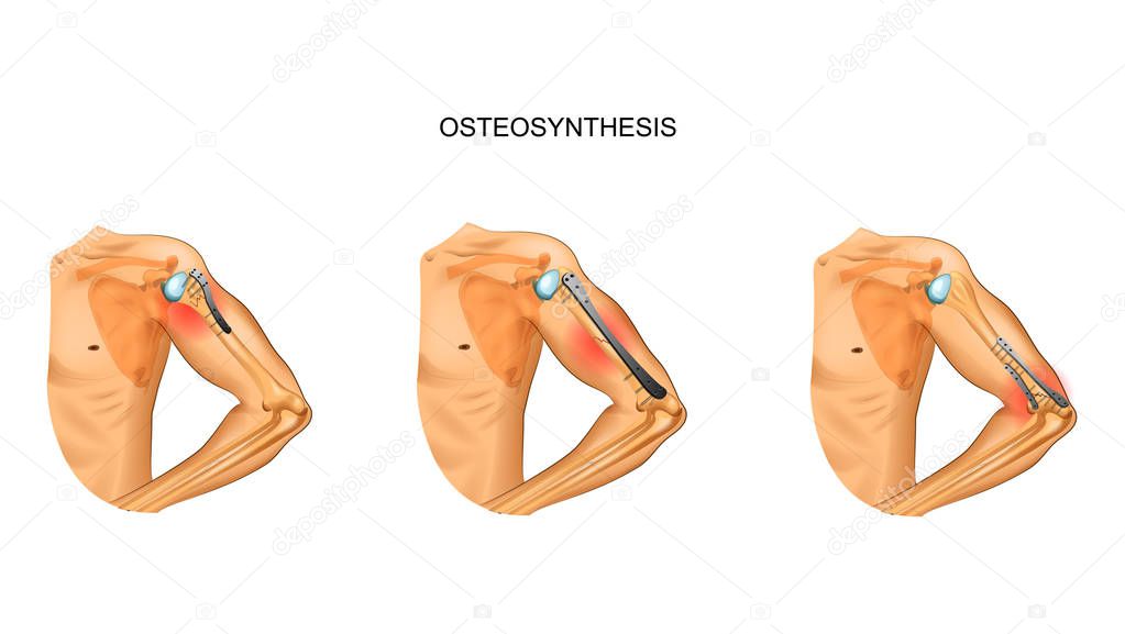 vector illustration of osteosynthesis of the humerus