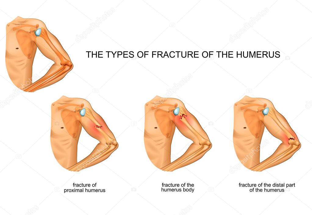 vector illustration of humerus fracture, trauma, surgery