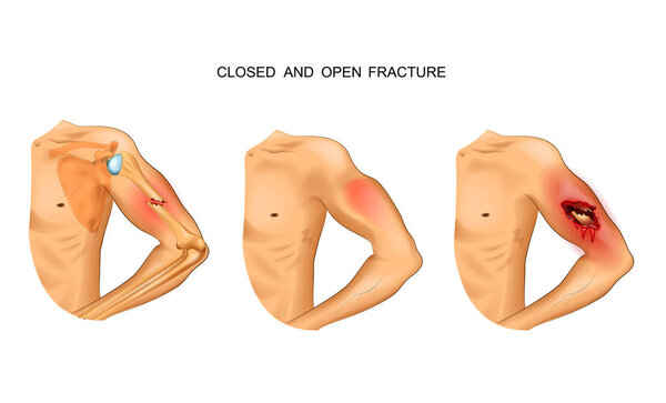 vector illustration of open and closed fracture