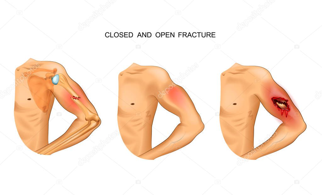 vector illustration of open and closed fracture