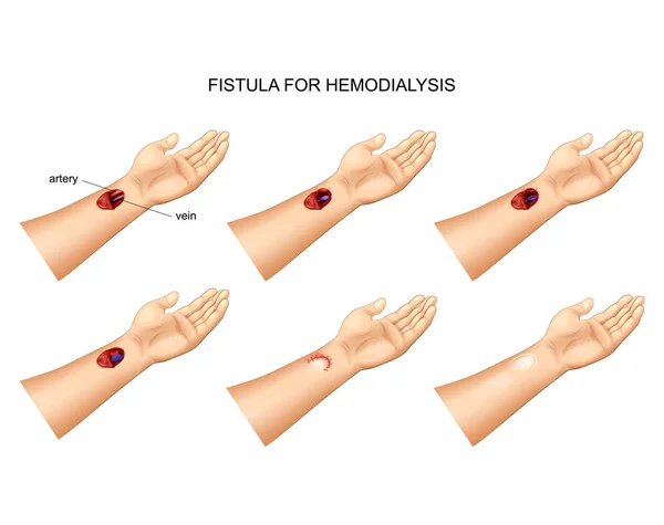 Ilustración Vectorial Instalación Una Fístula Para Hemodiálisis — Archivo Imágenes Vectoriales