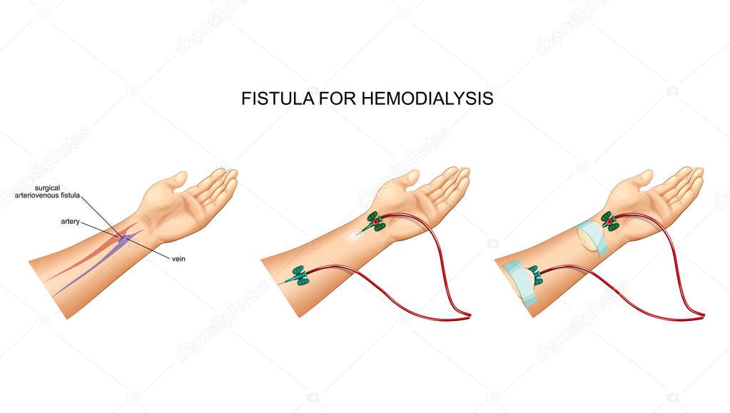 vector illustration of intravenous catheter, hemodialysis and fistula