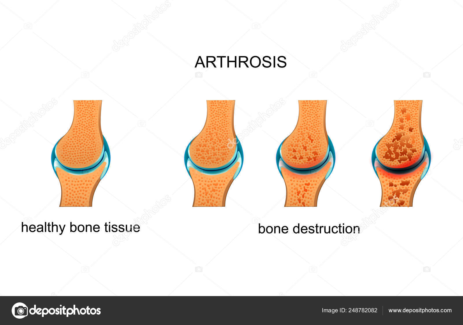 artrózis artritisz kenőcskezelés