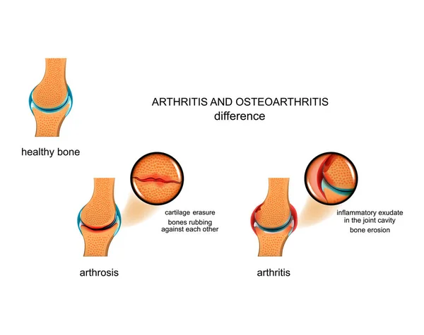 Unterschiede zwischen Arthrose und Arthritis — Stockvektor