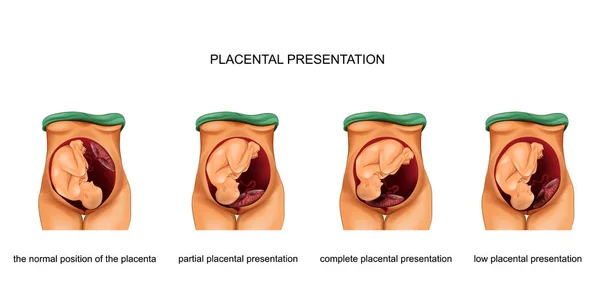 Placental presentation norm and pathology — Stock Vector