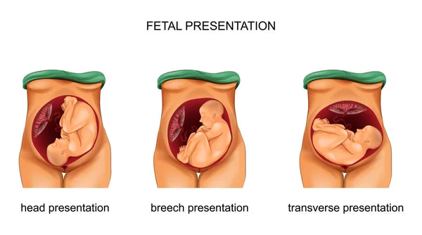 Presentación del feto. norma y patología — Archivo Imágenes Vectoriales