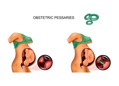 Hamilelik rahim serviks açılışında obstetrik pessarium kullanımı