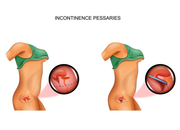 Einsatz von Pessar bei Inkontinenz — Stockvektor