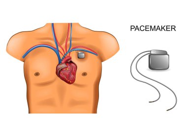 heart and pacemaker. cardiology clipart