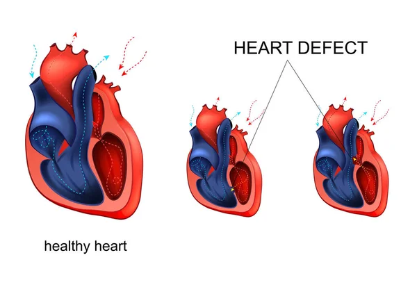 Doença cardíaca. defeito —  Vetores de Stock