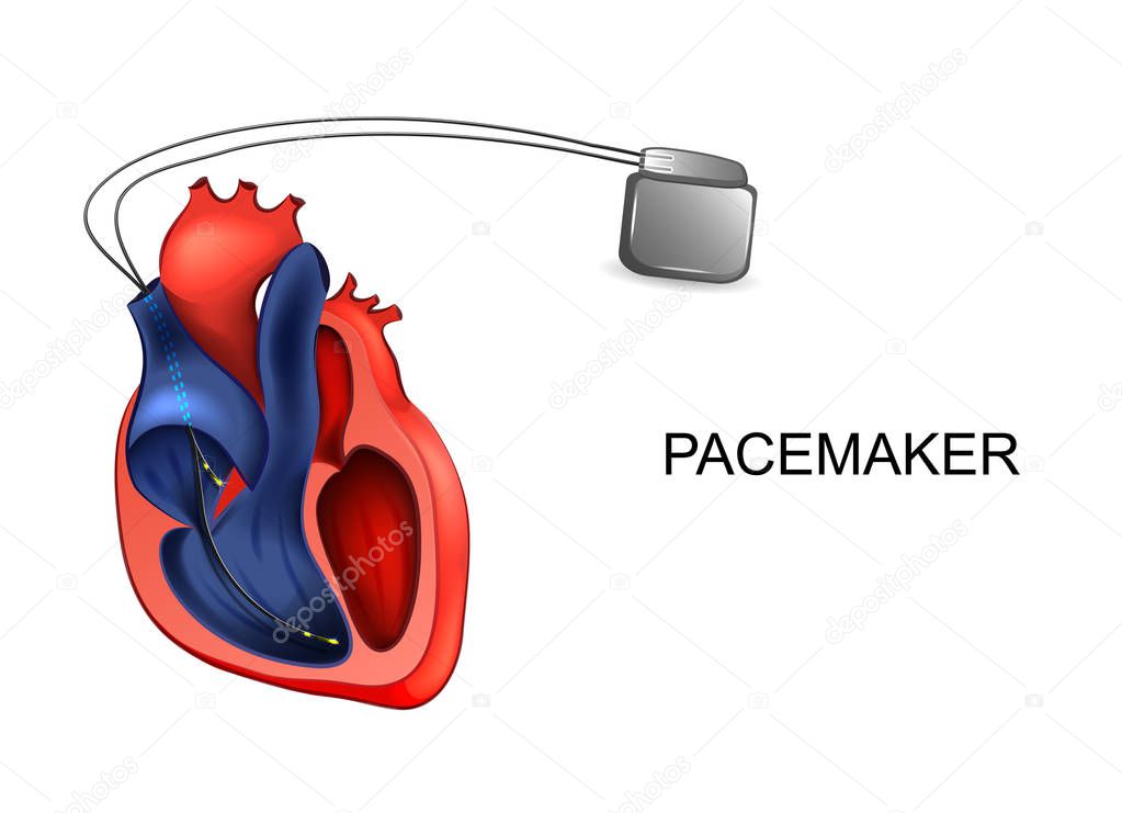heart and pacemaker. cardiology