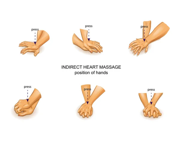 Posición de las manos del médico en el masaje cardíaco indirecto — Vector de stock