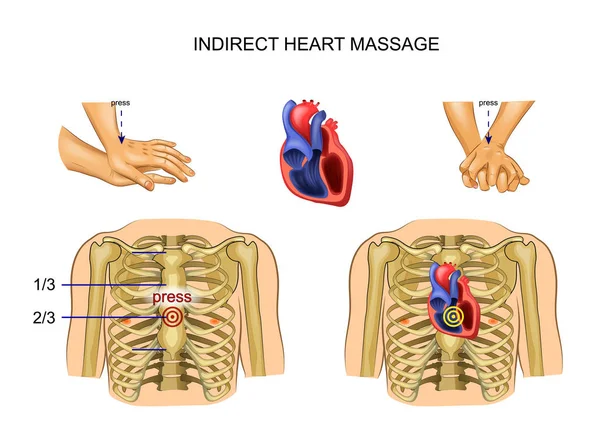 Косвенный массаж сердца — стоковый вектор