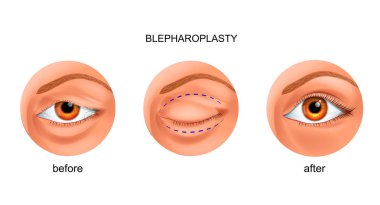 taşkın göz kapağı Blefaroplasti