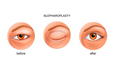 blepharoplasty of the Asian eyelid clipart